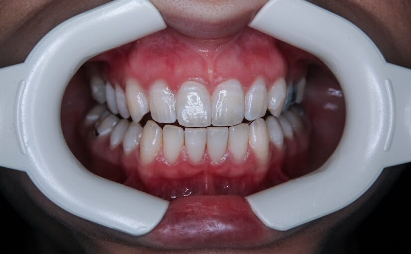 Tandblegning: En Guide til Lysere Smil
